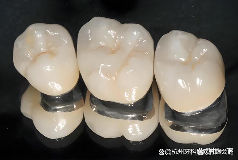 种植牙:新时代的牙齿守护者